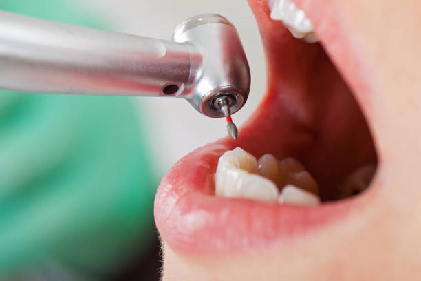 Best Emergency Tooth Extraction in Marshall, WI